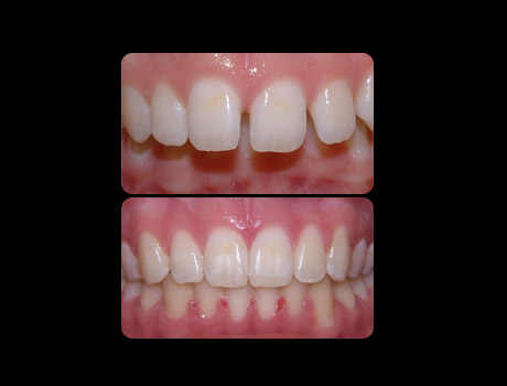 Spacing resolved in 17 months with full upper and lower braces