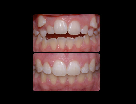 Openbite resolved in 20 months with full upper and lower braces