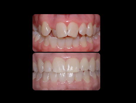 Crowding resolved in 30 months with full upper and lower Invisalign&reg;